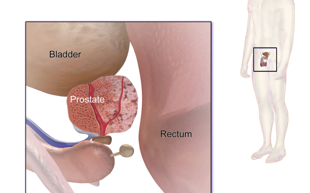 El Cáncer de Próstata y sus posibles síntomas.