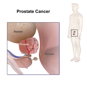 cáncer_próstata_síntomas