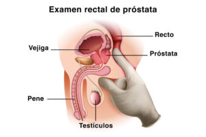 Examen rectal cáncer de próstata