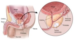 Diagrama del Cáncer de Próstata